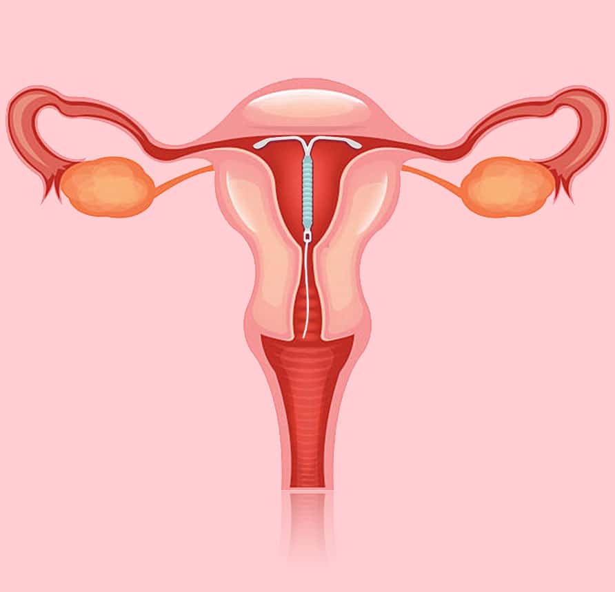 Everything you need to know about intrauterine contraceptive devices (IUD)